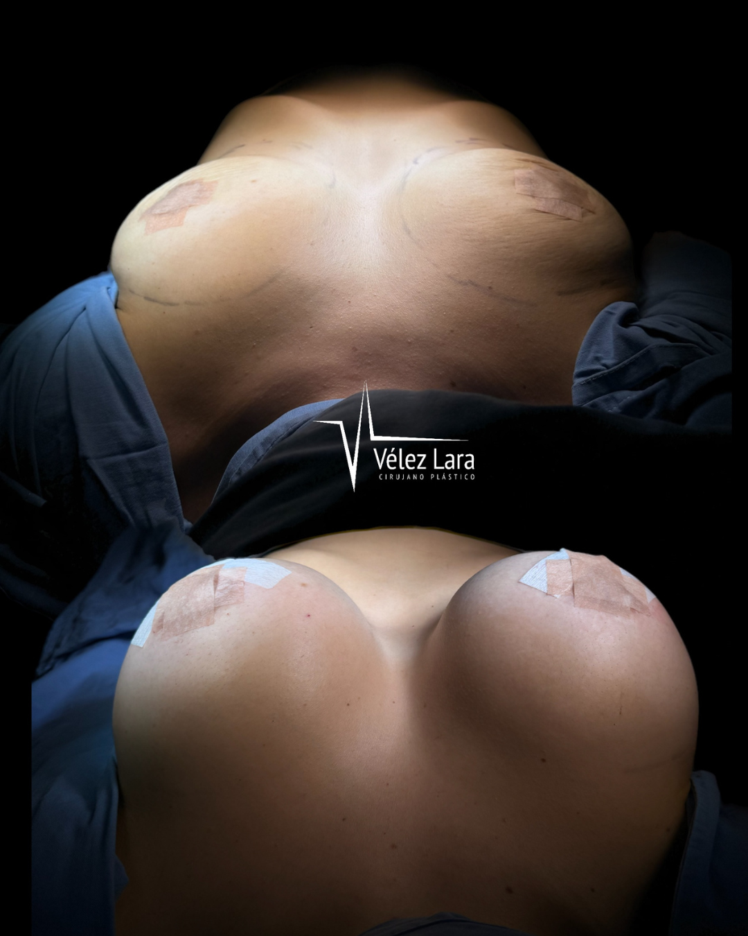 implantes_mamarios_drjuancarlosvelezlara